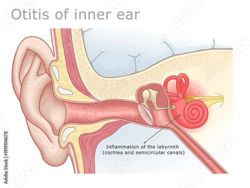 Medical illustration of otitis interna or labyrinthitis affecting the inner ear structures. Ear Anatomy Series.