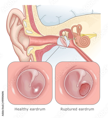 Ruptured eardrum illustration. Diagram showing a hole in the eardrum due to infection or trauma. Ear Anatomy Series.