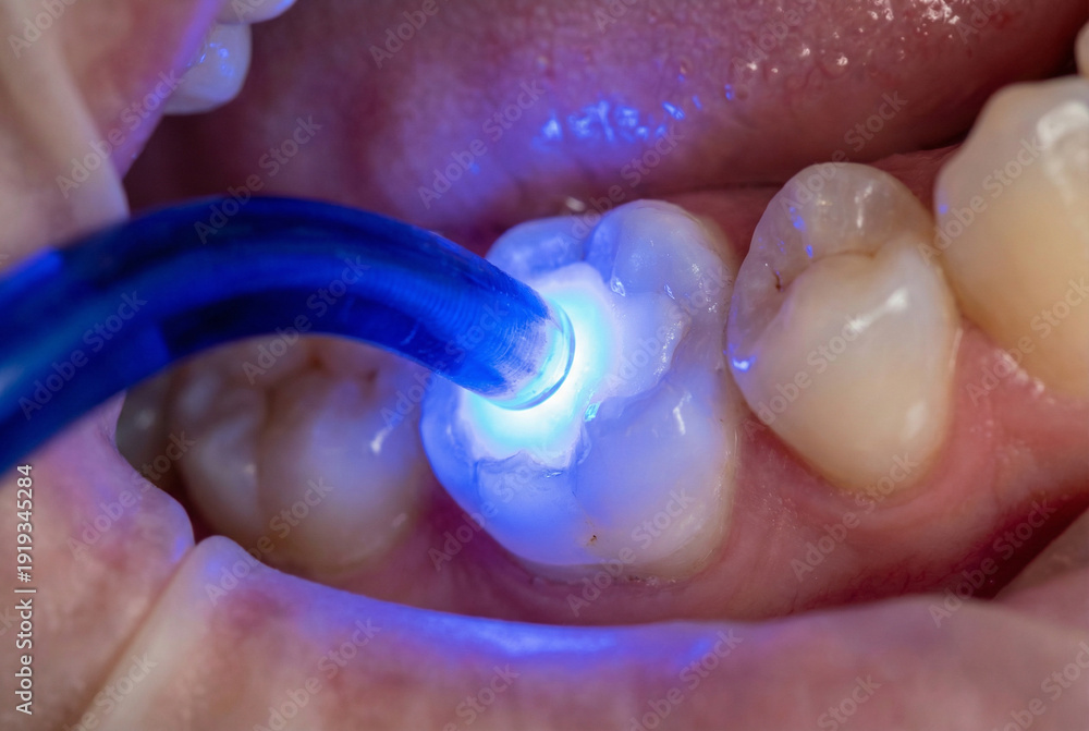 Fototapeta premium Dentist using blue UV curing light lamp on composite resin filling in patient molar tooth