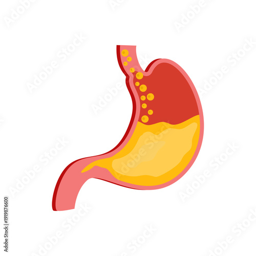 GERD Gastroesophageal Reflux Disease in Stomach