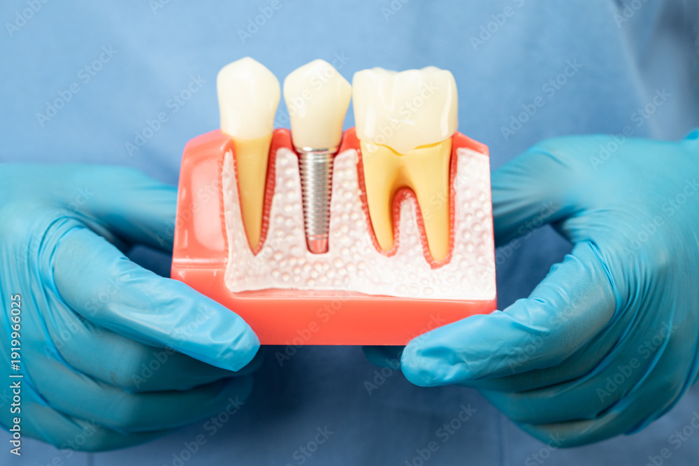 Ταπετσαρία Asian dentist holding dental implant, artificial tooth roots into jaw, root canal of dental treatment, gum disease, teeth model for dentist