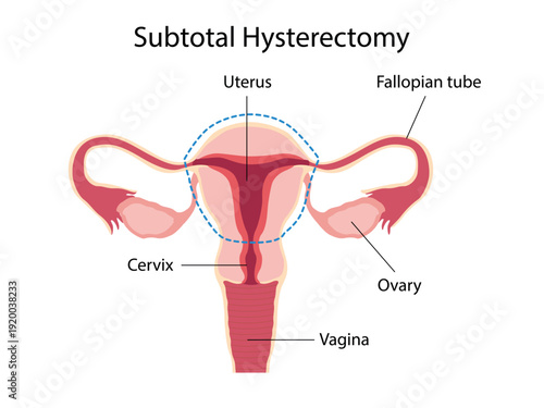 Subtotal Hysterectomy. Surgical removal of the uterus. Female anatomy. Vector Medical diagram for gynecology. 
