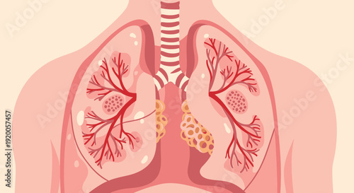 Human lungs anatomy with bronchitis illustration.