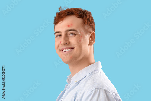 Teenage boy with acne on bl...