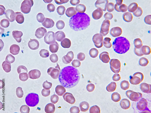 Acute leukemia. WBC grossly increased in number, left shift, atypical looking large mononuclear cells with nucleoli. 