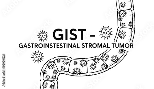 GIST - Gastrointestinal Stromal Tumor Concept Icon with Intestine Diagram.