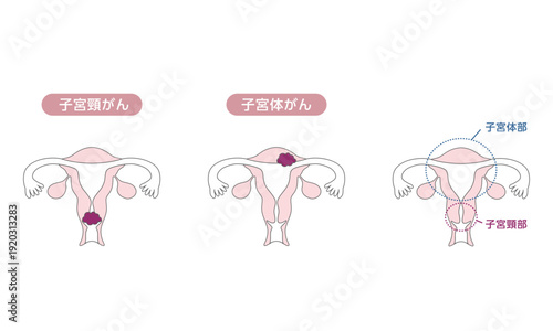 子宮頸がんと子宮体がんの違いを示す医療イラスト
