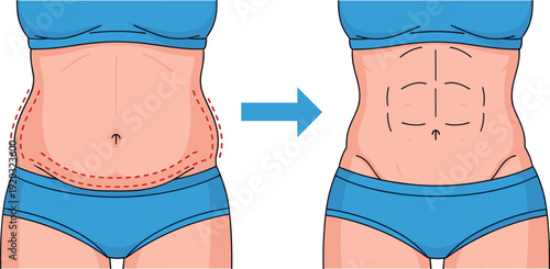 Abdominal fat reduction concept before and after belly weight loss transformation vector illustration