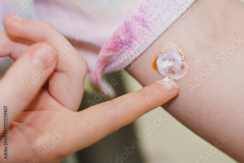 Photos Treatment of ringworm lesion on skin surface during care session