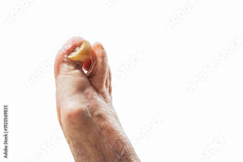 Foot with deformed yellow nail. Onychogryphosis or rams horn nail. Medical and health issue concept for diagnosis, treatment.