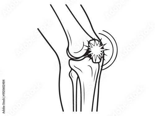 Human Knee Illustration Set – Healthy and Injured Joint Anatomy Comparison VectorWeb