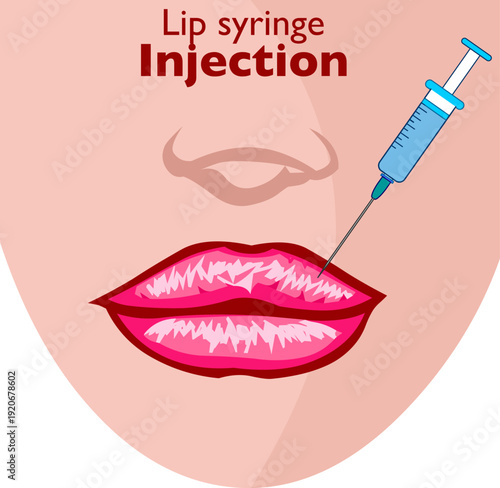 Lip syringe injection. Plastic surgery, hyaluronic acid filler aesthetic  Shiny full lips. Illustration vector