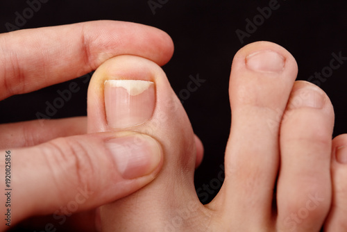 Closeup Of Toe Skin. Nail Detachment, Fungal Nail Infections, Onycholysis, Dermatologist, Therapeutic Pedicure, Examination Toenail, Skin. Careful Inspection Of Toe Skin And Nails, Closeup Macro shot
