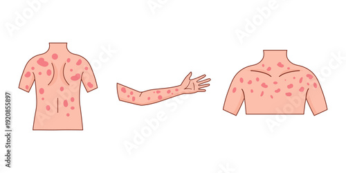Measles Virus Skin Symptoms Medical Illustration with Red Skin Rash on Torso and Arm.