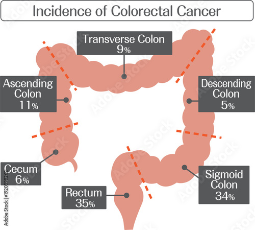 Large Intestine Diagram Showing Colorectal Cancer Incidence by Region
