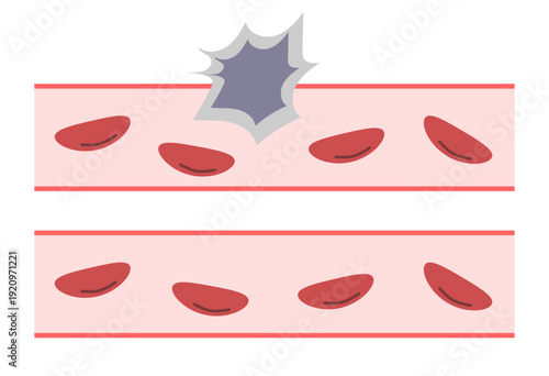 Cancer Cell Vascular Invasion Comparison Medical Illustration for Metastasis Concept