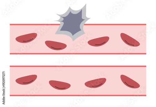 Cancer Cell Vascular Invasion Comparison Medical Illustration for Metastasis Concept