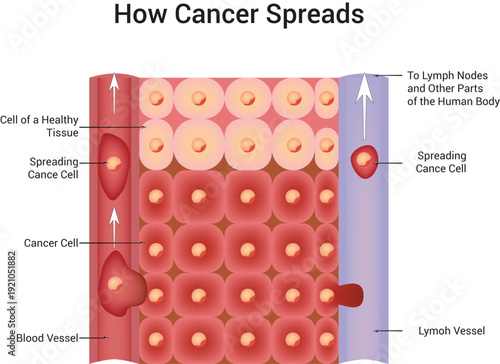 How Cancer Spreads Science Design Vector Illustration Diagram