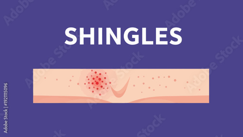 Shingles Rash on Skin Illustration