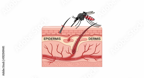 Detailed illustration of a mosquito biting human skin, showing the epidermis and dermis layers with blood vessels underneath.