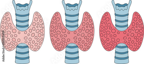 A medical illustration showing three identical simplified diagrams of human thyroids in a row.