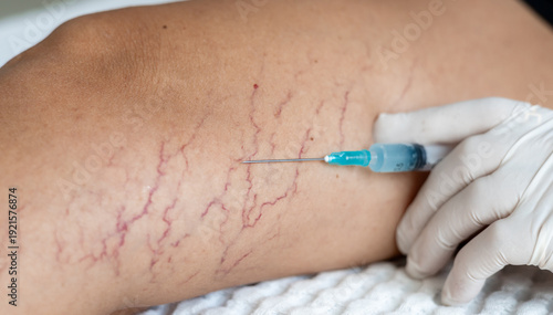Foto Sclerotherapy procedure for spider veins on female leg