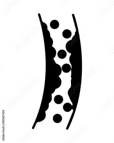 Artery with plaque illustration