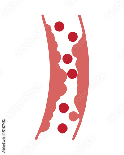 Atherosclerosis medical illustration