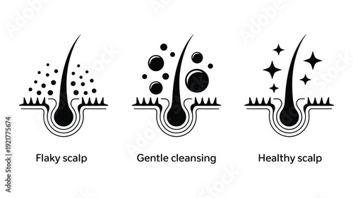Three stages of scalp health showing flaky gentle cleansing and healthy scalp keywords: hair follicle