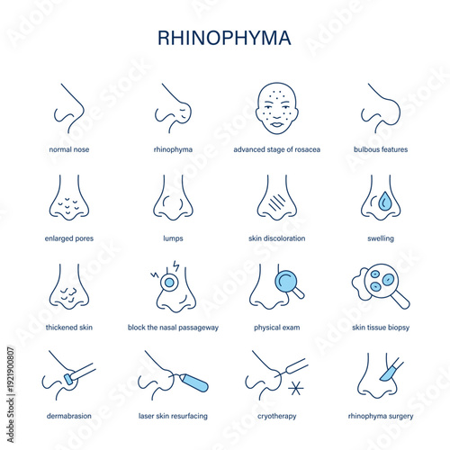 Rhinophyma symptoms, diagnostic and treatment vector icon set