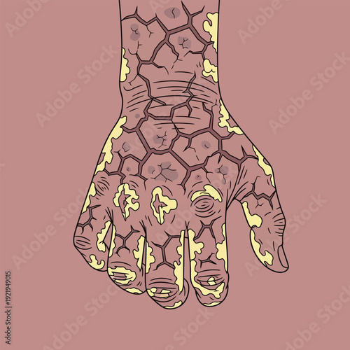 Severe Hand Dermatitis Medical Illustration