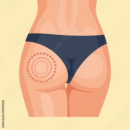 Fractional Laser Treatment Marks on Woman Buttocks