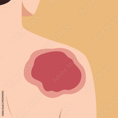 Severe Skin Burn or Inflammation on Shoulder Illustration