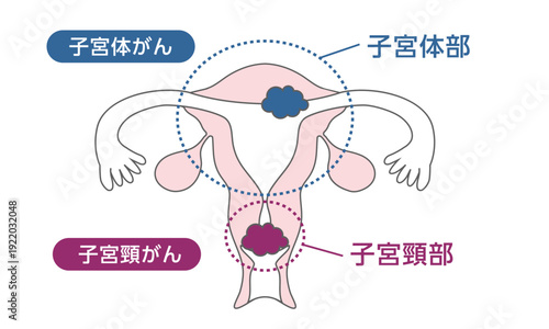 子宮頸がんと子宮体がんの医療イラスト