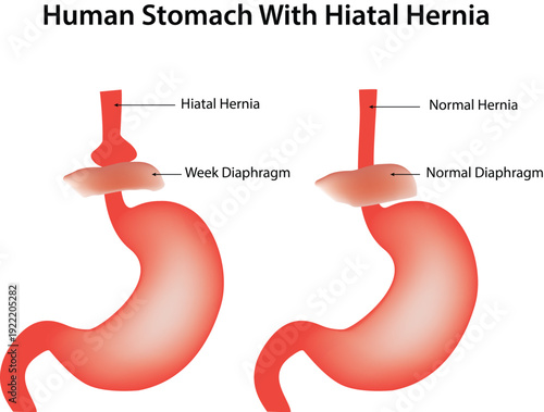 Human Stomach With Hiatal Hernia Science Design Vector Illustration Diagram