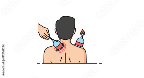 Traditional cupping therapy procedure being performed on a patient back to improve blood flow and relieve muscle tension or pain.