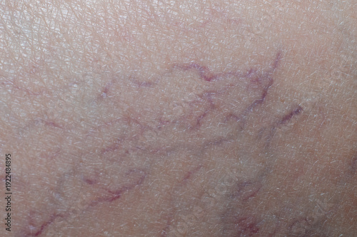 A fragment of human skin with varicose veins.