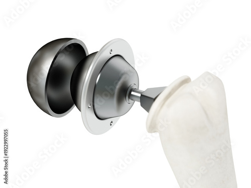 3D illustration of shoulder replacement surgery on transparent background. 3D illustration