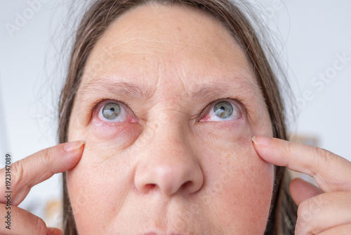 Fotografie female eye with visible redness, severe swelling, Clinical observation periorbit