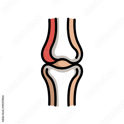 A medical illustration of a knee joint with inflamed tendon