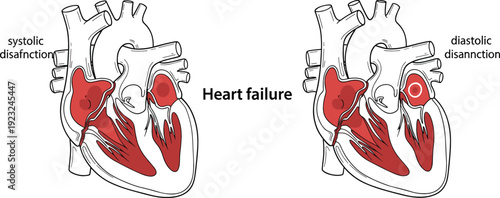 Medical illustration of heart failure showing cross section of human heart with systolic dysfunction and diastolic dysfunction comparison diagram