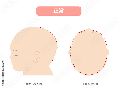 横と真上から見た頭の形が正常な赤ちゃんのイラスト　斜頭症,短頭症,長頭症との比較