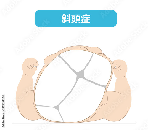 赤ちゃんが寝ている頭の向きによって頭の形に歪みが生じるメカニズム、斜頭症,短頭症,長頭症の赤ちゃんのイラスト