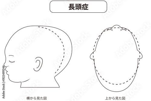 白黒線画　横と真上から見た頭の形に歪みがある斜頭症,短頭症,長頭症の赤ちゃんのイラスト