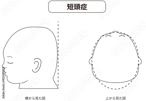 白黒線画　横と真上から見た頭の形に歪みがある斜頭症,短頭症,長頭症の赤ちゃんのイラスト