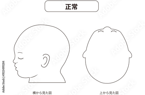白黒線画　横と真上から見た頭の形が正常な赤ちゃんのイラスト　斜頭症,短頭症,長頭症との比較