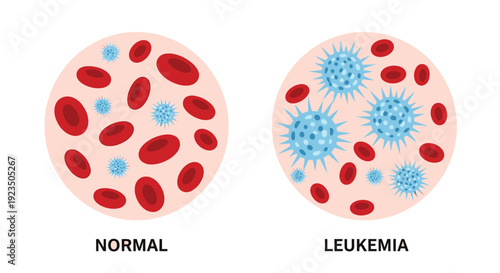 Visualizing the stark contrast between normal healthy blood cells and those affected by leukemia.