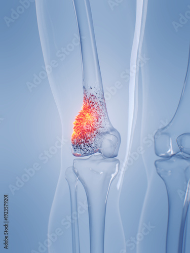 A Detailed 3D Depiction Of Osteosarcoma In A Human Male