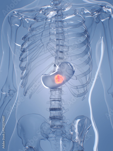 A Detailed 3D Depiction Of Stomach Cancer In A Human Male