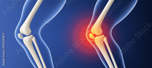 Healthy and painful knee joint comparison. Vector realistic illustration